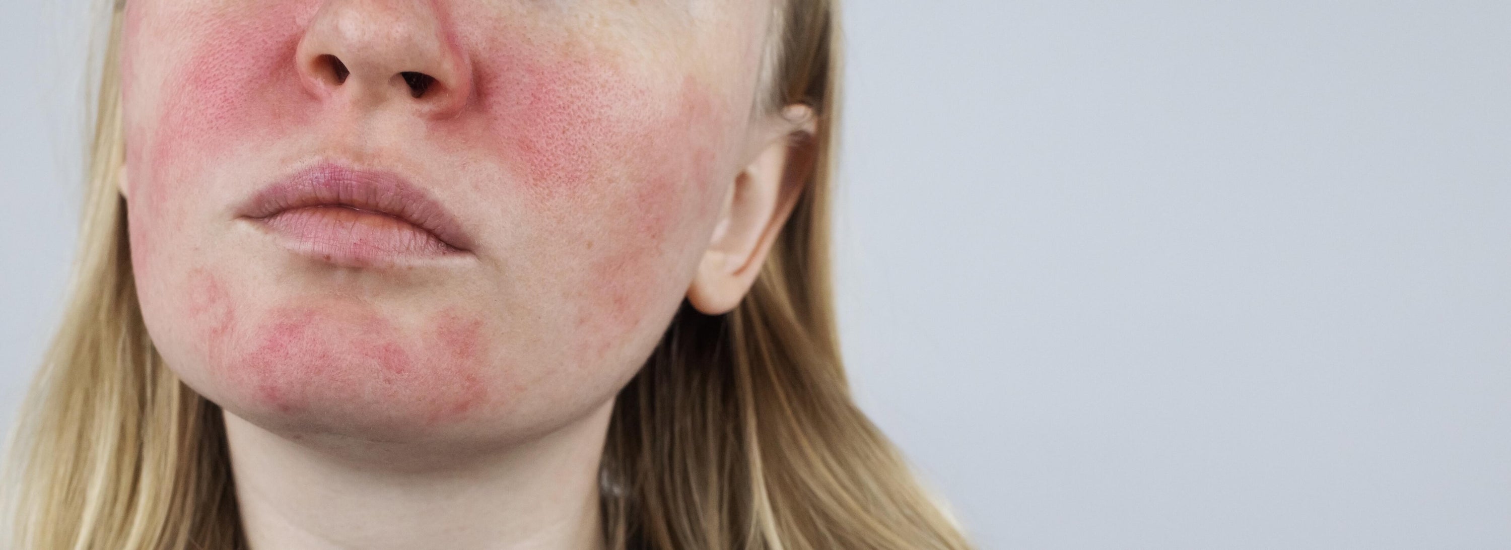 EFFECTIVE WAYS TO GET RID OF REDNESS ON YOUR FACE